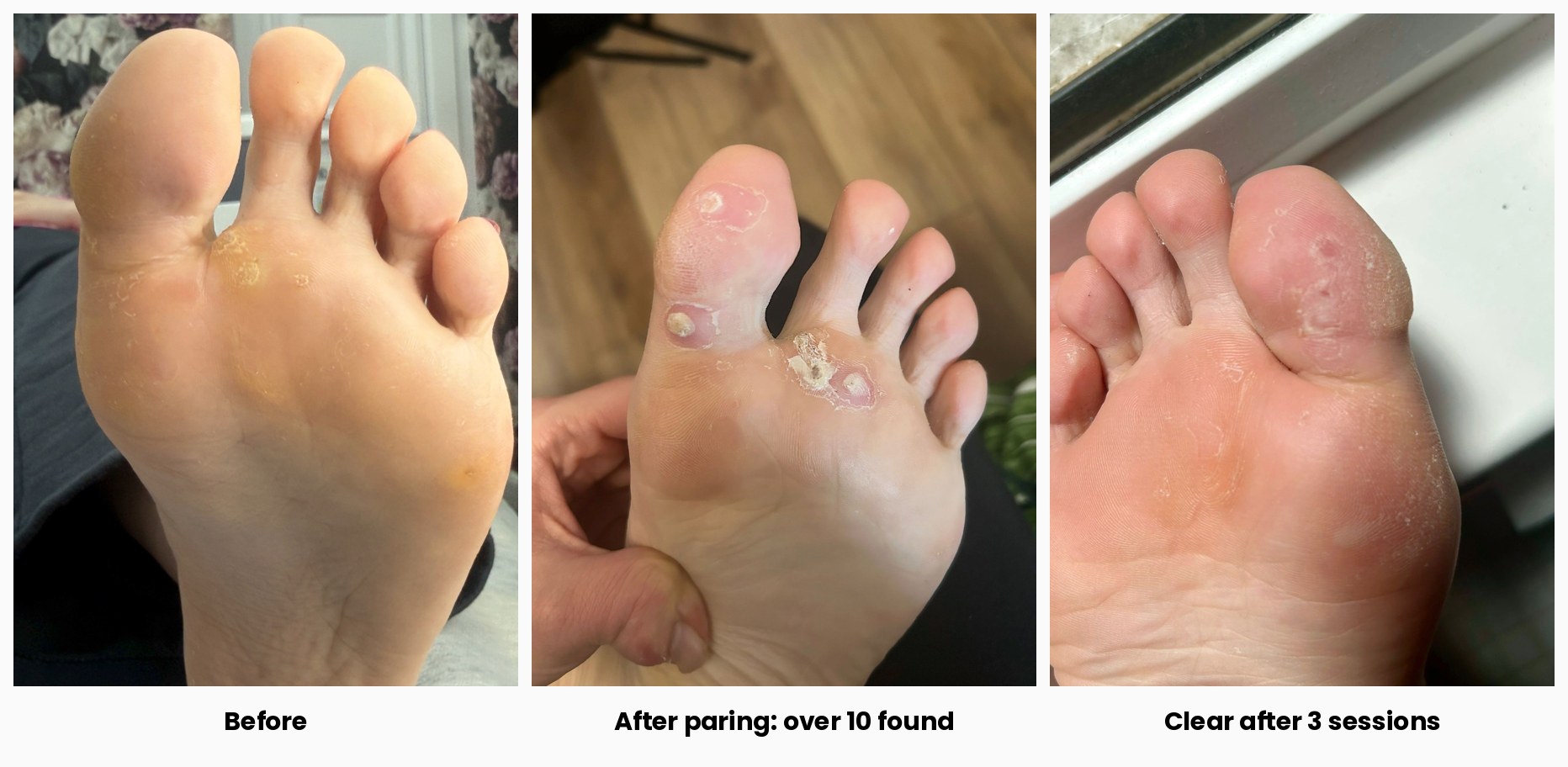 Verruca Removal in Newcastle: Clear After 3 CryoPen Sessions