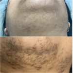 facial hair treatment at Glamaholic Salon